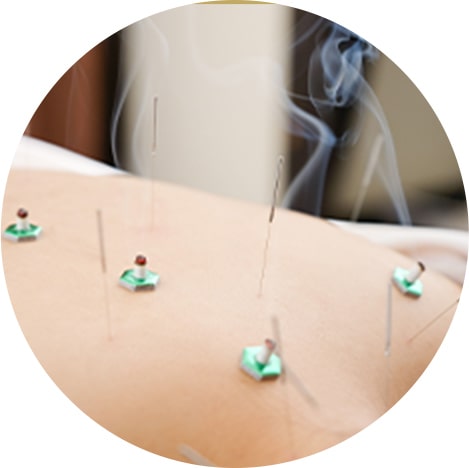 鍼灸院での自費診療メニューとして活用されるラクリスの施術シーン